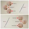 Suvorna Ador Skin Care Pimple Blemish Remover & Comedone Extractor With Needle Point Lancet 1112 view 2