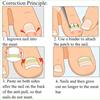 10Pcs Ingrown Toenail Straightening Clip Ingrown Toenail Correction Elastic Patches Paronychia Acronyx Correction Patch Foot Care Tool view 4