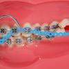 Colourful Orthodontic Spool Elastic Rubber Elastic Rubber Band Power Chain for Braces Short Long Continuous Sizes Orthodontic Treatment 1 pc (Long, Sky blue) view 2