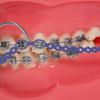Colourful Dental Orthodontic Elastic Rubber Band Power Chain for Braces Short Long Continuous Sizes Orthodontic Treatment 1 pc (Open, Violet) view 2