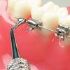 NMD Dental NiTi Thermal Heat Activated Orthodontic Archwires (LOWER, 17 * 25) (Pack Of 10Pc) view 2
