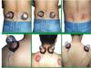 ACP Acupressure Electric Tens with cupping Tens Machine | Vacuum Cupping Set for Health Care | Cupping Kit for Pain Relief view 4