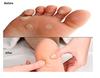 Callus Corn Hard Tough Skin Remover Shaver Foot Pedicure Kit (ONLY 25PCS BLADES) (Corn Remover) view 2