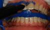 Dengen Dental Dam Dengodam Gingival barrier view 3