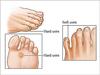 CTM EXPORTS A.K.S Ointment for Kaal Aani Cream - Foot Corn Remover, Hand Corn Remover, Callus Remover, Kapasi Remover Cream/Malam (10g) (2) view 4