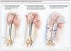 DEBIK | Humeral Brace arm support humerus fracture brace (SMALL) view 3