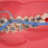 Colourful Dental Orthodontic Elastic Rubber Band Power Chain for Braces Short Long Continuous Sizes Orthodontic Treatment 1 pc (Long, Blue 1#) view 2