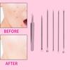 6 Packs Pimple Popper and Blackhead Remover Tool Kit, Professional Stainless Steel Removal Tool of Blackhead Whitehead Pimple for Women and Men view 4