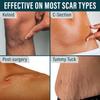 NUVADERMIS Silicone Scar Tape for Surgical Scars - 60" x 1.5" Roll - Extra Long Scar Sheets for C-Section, Tummy Tuck, Keloid, and Surgical Scars - Reusable Medical Grade Silicone Scar Tape view 4