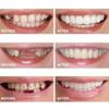 Teeth Brace Cover Instant Smile Teeth Veneers Beautiful Smile Dentures Veneers Fake, Veneers Dentures Socket for Women and Men, Dental Veneers for Temporary Tooth 2pcs Repair view 2