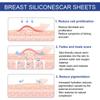Silicone Scar Sheets, Silicone Scar Sheets for Breast 8 Pack, Breast Reduction After Surgery for Scars, Scar Removal Sheets, 4 Areola Soft Strips & 4 Anchor Sheets view 3
