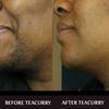 TEACURRY Facial Hair Removal Green Tea(3 Month Pack|90 Tea Bags)-Helps With Facial Hair Removal And Unwanted Hair Removal,180 Grams view 3