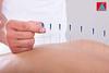 4beauty Therapy Acupuncture Needles Tube Pck 100-3''/.25x75mm Red Box view 3
