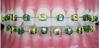 DENTAL TOOL Ortho Elastics (GREEN) view 4