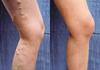 DClub Thigh High Graduated Compression Stockings Open-Toe 23-32mmHg Firm Medical Support Socks for Varicose Veins. (Beige, M) view 2
