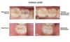 SHOFU BEAUTISEALANT PASTE 1.2G view 3