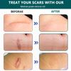 1 Roll Silicone Scar Sheets Waterproof Cica Care Gel Sheets Wound Repair Desalination Strip Scar Removal Sticker for Surgery Injury Burns Scars view 2
