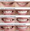 Supplyspot Cosmetic Tooth Cover Snap On view 3