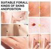 Auto Skin Tag Remover Kit, 2 in 1 Skin Tag Remover, Skin Tag Removal Kit for Removing Small to Medium view 2