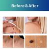 YELURI PRODUCTSSkin Tag & Mole Remover Serum Fast-Acting Natural Formula for Clear, Smooth, Even-Toned Skin 10ml view 3