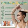 Ayurvedic Intimate area Vitiligo Cream with Natural Ingredients like Aloe, Turmeric, and Saffron, Helps Restore Healthy Skin, Reduces White Spots & Provides a Brighter and Even Skin Tone view 4